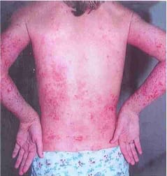 Eczema 2
